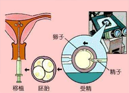 借卵做试管婴儿特别聪明值得信赖海参威好吗