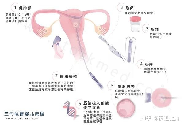 腺肌症难孕，供卵试管婴儿一举成名