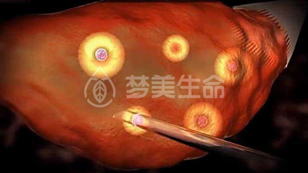子宫内膜异位症可以做赠卵试管婴儿吗
