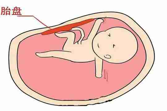 巨大儿剖腹产出生体重10斤,怎么给孩子补充维生素D？